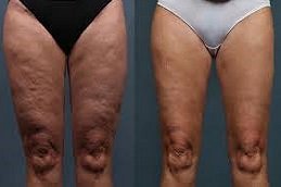 cellulite removal treatment in Riyadh & Saudi Arabia