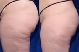 cellulite removal treatment in Riyadh & Saudi Arabia