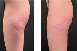 cellulite removal treatment in Riyadh & Saudi Arabia