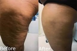 cellulite removal treatment in Riyadh & Saudi Arabia