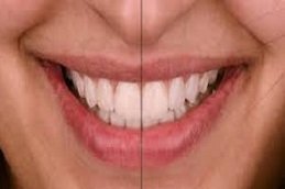 Digital Smile Design in Riyadh & Saudi Arabia