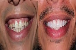 Digital Smile Design in Riyadh & Saudi Arabia