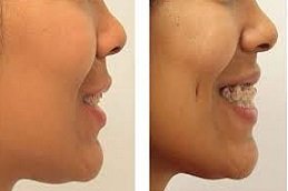 Dimple creation treatment in Riyadh & Saudi Arabia