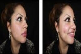 Dimple creation treatment in Riyadh & Saudi Arabia