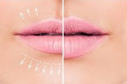 fotona 4D lip augmentation in Riyadh and Saudi Arabia