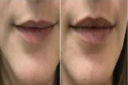 fotona 4D lip augmentation in Riyadh and Saudi Arabia