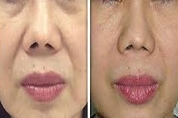 fotona 4D lip augmentation in Riyadh and Saudi Arabia