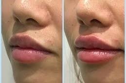 fotona 4D lip augmentation in Riyadh and Saudi Arabia