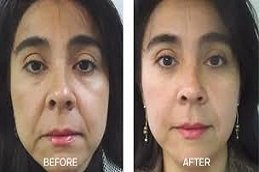 fotona 4D lip augmentation in Riyadh and Saudi Arabia