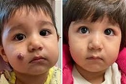 Hemangioma treatment in Riyadh and Saudi Arabia