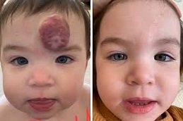 Hemangioma treatment in Riyadh and Saudi Arabia