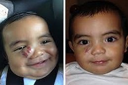 Hemangioma treatment in Riyadh and Saudi Arabia