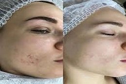 Laser carbon peel treatment in Riyadh and Saudi Arabia