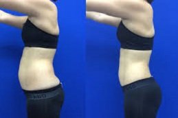 Laser Fat Reduction in Riyadh & Saudi Arabia