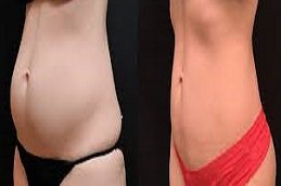 Laser Fat Reduction in Riyadh & Saudi Arabia