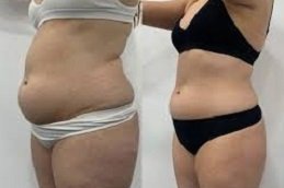 Laser Fat Reduction in Riyadh & Saudi Arabia