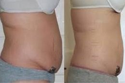 Laser Lipolysis treatment in Riyadh & Saudi Arabia