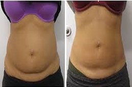 Laser Lipolysis treatment in Riyadh & Saudi Arabia