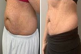 Laser Lipolysis treatment in Riyadh & Saudi Arabia