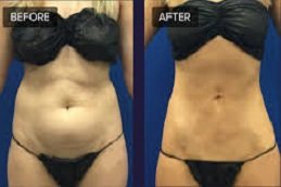 Laser Lipolysis treatment in Riyadh & Saudi Arabia