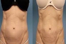 Laser Lipolysis treatment in Riyadh & Saudi Arabia