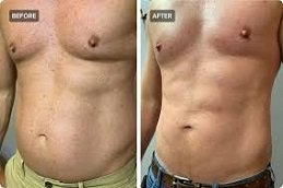 Laser Lipolysis treatment in Riyadh & Saudi Arabia