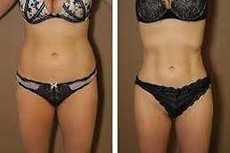 Laser Liposuction in Riyadh & Saudi Arabia