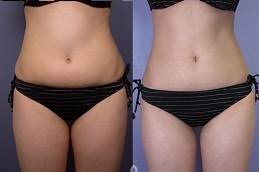 Laser Liposuction in Riyadh & Saudi Arabia