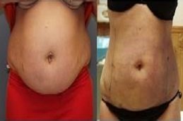 Laser Liposuction in Riyadh & Saudi Arabia