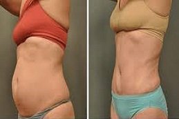 Laser Liposuction in Riyadh & Saudi Arabia