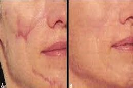 Laser Scar Removal in Riyadh & Saudi Arabia