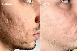 Laser Scar Removal in Riyadh & Saudi Arabia