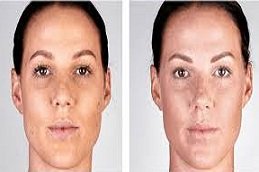 Laser Skin Tightening in Riyadh and Saudi Arabia