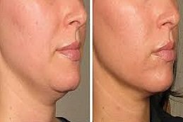 Laser Skin Tightening in Riyadh and Saudi Arabia