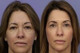 Laser Skin Tightening in Riyadh and Saudi Arabia