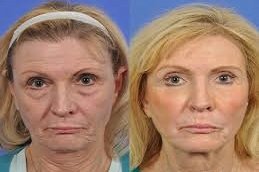 Laser treatment for the face in Riyadh and Saudi Arabia