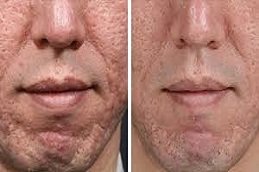 micro needling for acne scars in Riyadh and Saudi Arabia