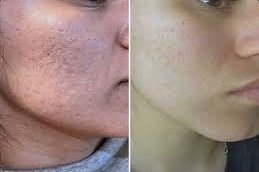 micro needling for acne scars in Riyadh and Saudi Arabia