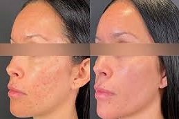 micro needling for acne scars in Riyadh and Saudi Arabia