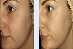 micro needling for acne scars in Riyadh and Saudi Arabia