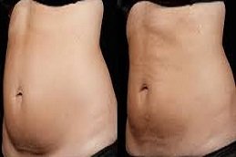 Non-Invasive Fat Removal in Riyadh and Saudi Arabia