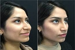 Non-Surgical Nose Job in Riyadh and Saudi Arabia