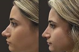 Non-Surgical Nose Job in Riyadh and Saudi Arabia