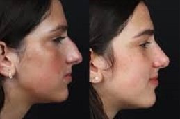 Non-Surgical Nose Job in Riyadh and Saudi Arabia