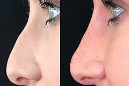 Non-Surgical Nose Job in Riyadh and Saudi Arabia