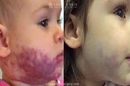 port wine stain treatment in Riyadh & Saudi Arabia