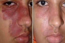 port wine stain treatment in Riyadh & Saudi Arabia