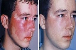 port wine stain treatment in Riyadh & Saudi Arabia