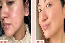 Radiofrequency for Acne Scars in Riyadh and Saudi Arabia