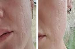 Radiofrequency for Acne Scars in Riyadh and Saudi Arabia